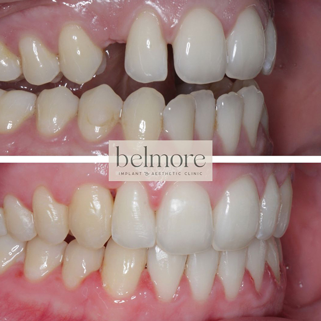 Oral Surgery & Bisphosphonates. Dental Blog Belmore Dental Implant