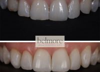 composite-bonding