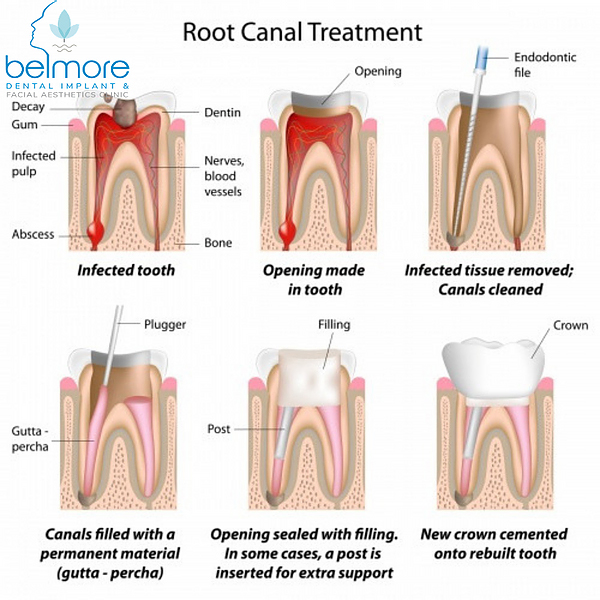 root-canal-treatment